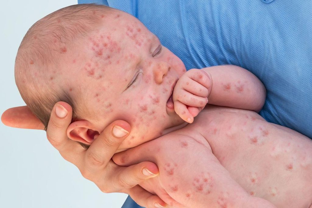 Two St. Croix Senators Warn Of Dangers Of Measles Outbreak On U.S. Mainland