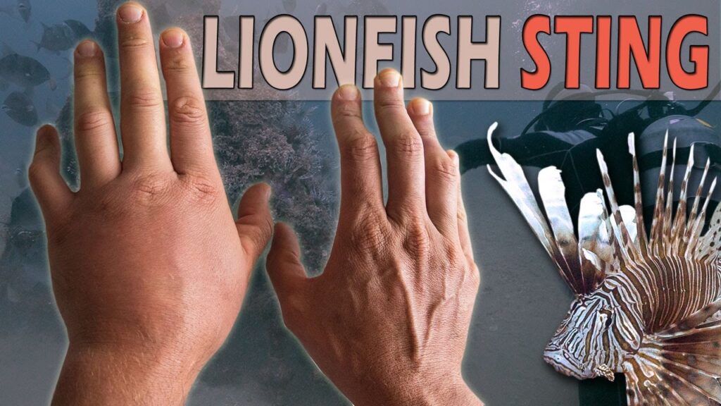 Radio Personality Stung By Lionfish Near Shoys Beach Taken By Ambulance To Hospital Recovering Well