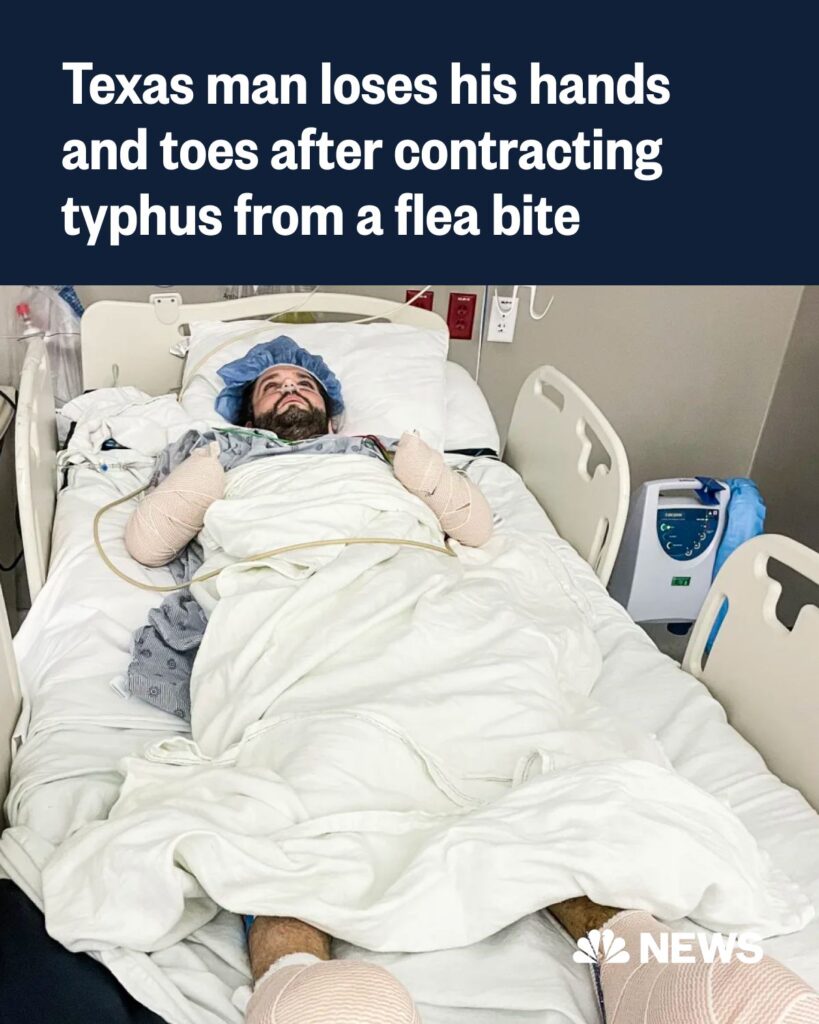 Texas man has hands and toes amputated after contracting typhus from a flea bite