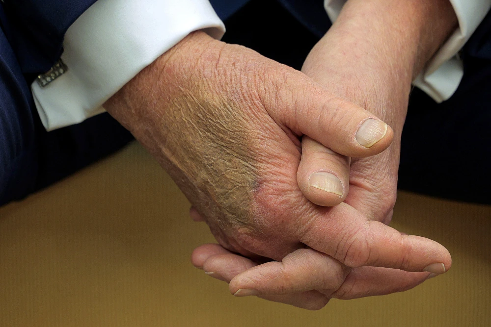 ‘Really concerning’: Massive bruise spotted on Trump’s right hand, sparks frenzied speculation online
