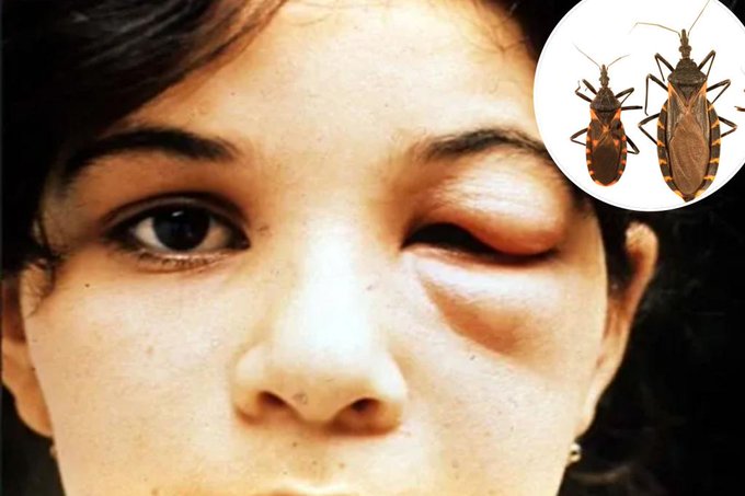 Experts say deadly ‘kissing bug’ infestations from Latin America now ENDEMIC in at least 32 states