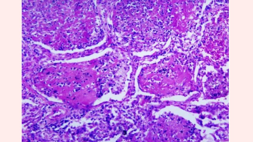 FUNGAL OUTBREAK IN TENNESSEE: Histoplasmosis Sickens Dozens, One Death Under Investigation