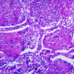 FUNGAL OUTBREAK IN TENNESSEE: Histoplasmosis Sickens Dozens, One Death Under Investigation